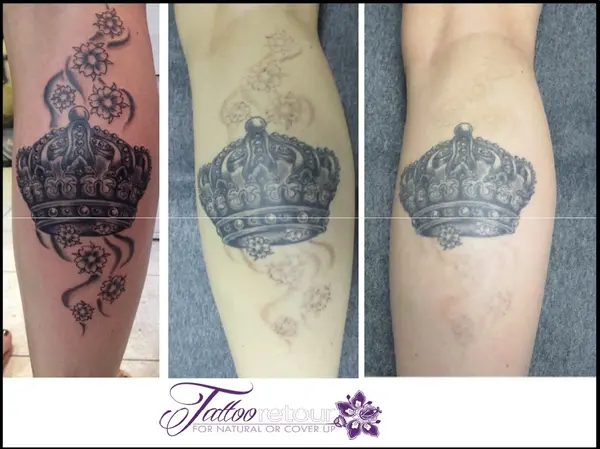 Vorher-nachher-Vergleich einer Tattooentfernung mit Krone und Blumenmotiv am Bein.
