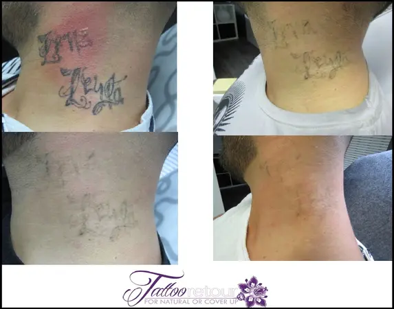 Tattooentfernung am Hals bei einem Mann, schrittweise verblassendes Tattoo sichtbar.