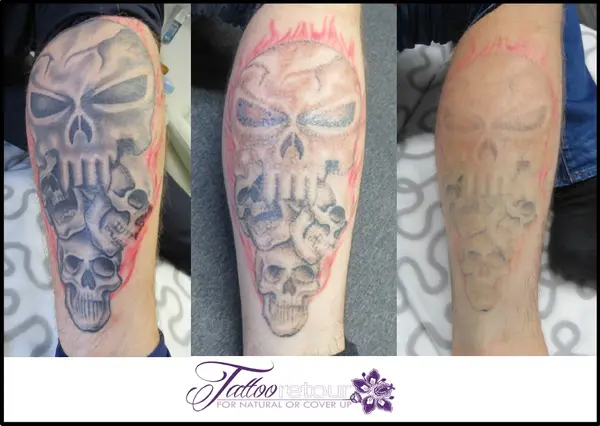 Drei Phasen der Tattooentfernung mit Laser an einem Unterarm mit Totenkopf-Motiv.