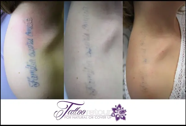 Vergleich der Tattooentfernung am Arm in drei Phasen, Tattoo wird zunehmend heller.