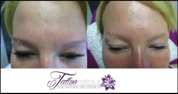 Vorher-nachher Vergleich der Tattooentfernung an den Augenbrauen einer Frau.